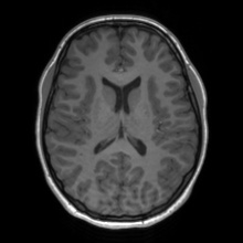 Cerebral cavernous venous malformation (Radiopaedia 70008-80021 Axial T1 44).jpg