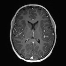 Cerebral cavernous venous malformation (Radiopaedia 70008-80021 Axial T1 C+ 41).jpg