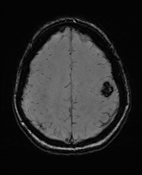 Cerebral cavernous venous malformation (Radiopaedia 70008-80021 I 57).jpg