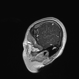 Cerebral cavernous venous malformation (Radiopaedia 70008-80021 Sagittal T1 C+ 7).jpg