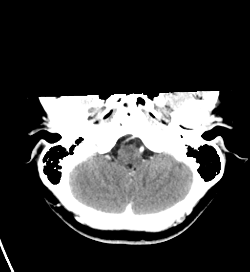 File:Cerebral cavernous venous malformations (Radiopaedia 48117-52945 Axial C+ delayed 8).png