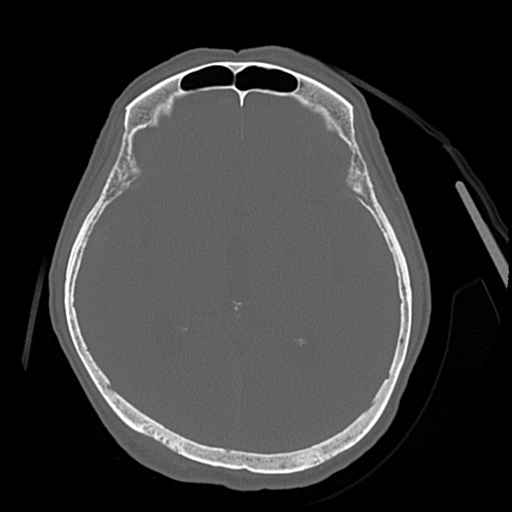 File:Cerebral contusions, subarachnoid hemorrhage and subdural hygromas (Radiopaedia 55399-61827 Axial bone window 26).png