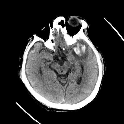 File:Cerebral contusions, subarachnoid hemorrhage and subdural hygromas (Radiopaedia 55399-61829 Axial non-contrast 20).png