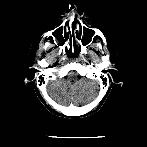 File:Cerebral edema (evolution in time) (Radiopaedia 19418-19441 non-contrast 17).jpg