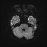 Cerebral embolic infarcts (embolic shower) (Radiopaedia 72391-82921 Axial DWI 38).jpg