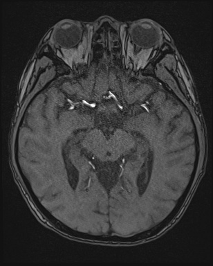 Cerebral embolic infarcts (embolic shower) (Radiopaedia 72391-82921 Axial MRA 71).jpg