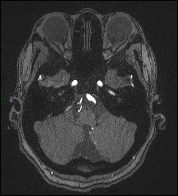 Cerebral fat embolism (Radiopaedia 35022-36525 Axial TOF 37).jpg