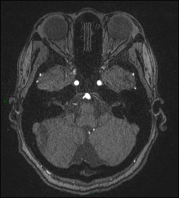 Cerebral fat embolism (Radiopaedia 35022-36525 Axial TOF 41).jpg
