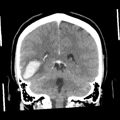 Cerebral hemorrhage secondary to arteriovenous malformation (Radiopaedia 33497-34561 C 44).png