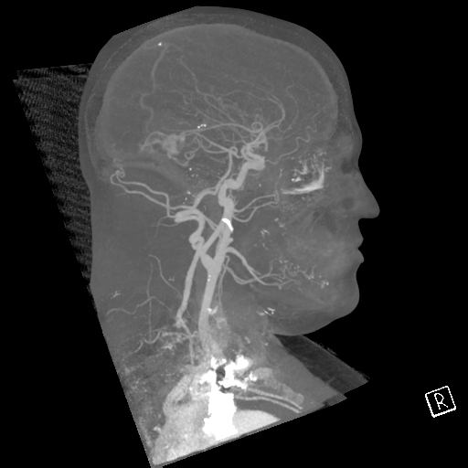 File:Cerebral hemorrhage secondary to arteriovenous malformation (Radiopaedia 33497-34571 A 29).png