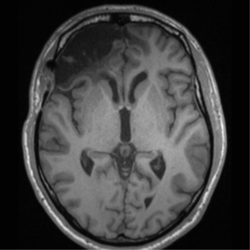 Cerebral hemorrhagic contusions- temporal evolution (Radiopaedia 40224-42757 Axial T1 37).png