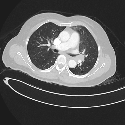 Cerebral metastases (Radiopaedia 33041-34055 Axial lung window 24).png