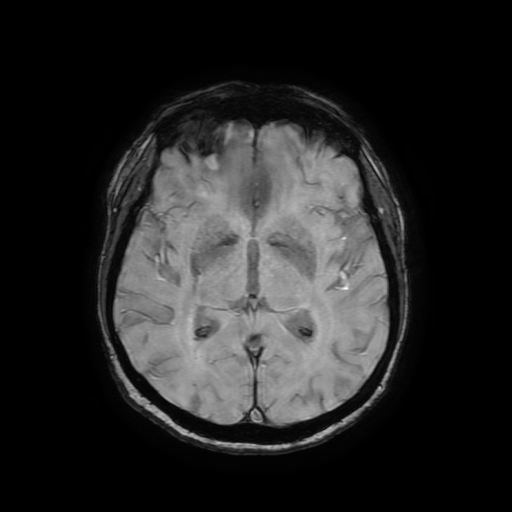 Cerebral metastases - melanoma (Radiopaedia 80972-94522 Axial SWI 50).jpg