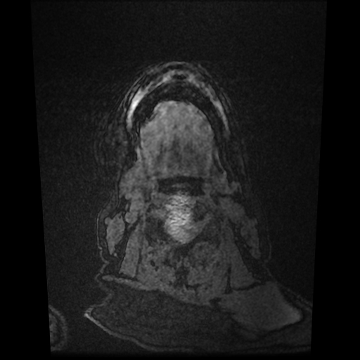 Cerebral metastases - melanoma (Radiopaedia 80972-94522 Axial T1 C+ 95).jpg