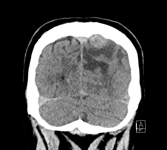 Cerebral metastases - testicular choriocarcinoma (Radiopaedia 84486-99855 Coronal C+ delayed 53).jpg