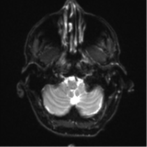 Cerebral metastasis - melanoma (Radiopaedia 54718-60954 Axial DWI 5).png