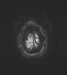 Cerebral metastasis - melanoma (Radiopaedia 54718-60954 Axial SWI 55).png