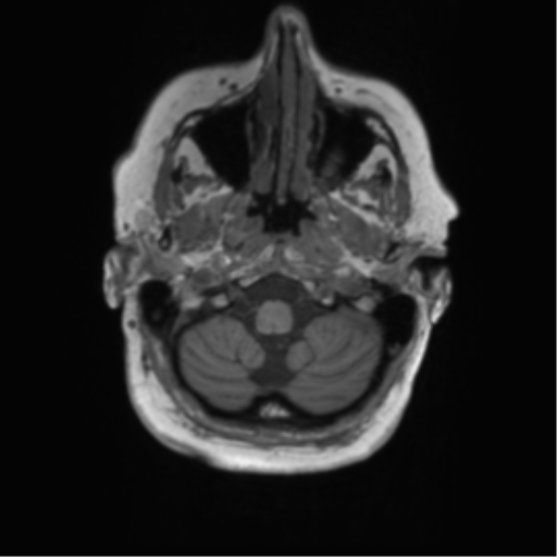 Cerebral metastasis mimicking glioblastoma (Radiopaedia 69155-78937 Axial T1 3).png