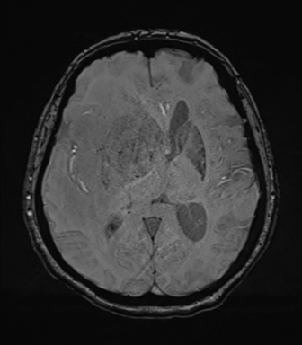 File:Cerebral metastasis to basal ganglia (Radiopaedia 81568-95413 Axial SWI 45).png