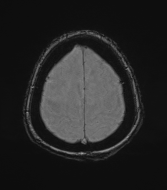 File:Cerebral metastasis to basal ganglia (Radiopaedia 81568-95413 Axial SWI magnitude 75).png