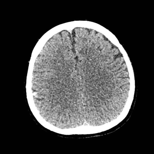 File:Cerebral ring enhancing lesions - cerebral metastases (Radiopaedia 44922-48818 Axial non-contrast 58).jpg