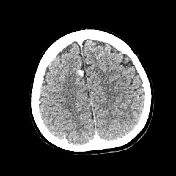 Cerebral ring enhancing lesions - cerebral metastases (Radiopaedia 44922-48818 B 212).jpg