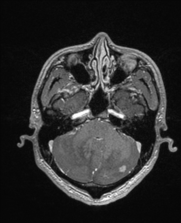 Cerebral toxoplasmosis (Radiopaedia 85779-101597 Axial T1 C+ 39).jpg