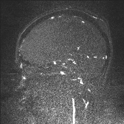 Cerebral tuberculosis with dural sinus invasion (Radiopaedia 60353-68090 Sagittal MRV 59).jpg