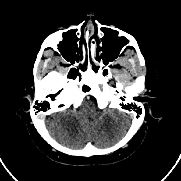 File:Cerebral venous hemorrhagic infarct from venous sinus thrombosis (Radiopaedia 55433-61883 Axial C+ delayed 121).jpg