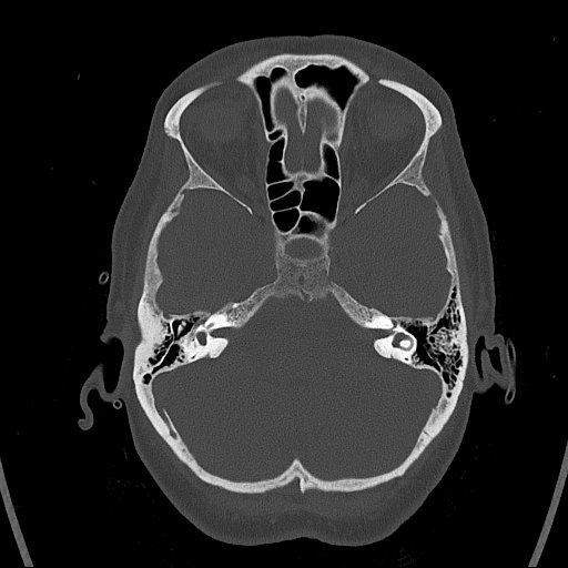 Cerebral venous infarction with hemorrhage (Radiopaedia 65343-74381 Axial bone window 30).jpg