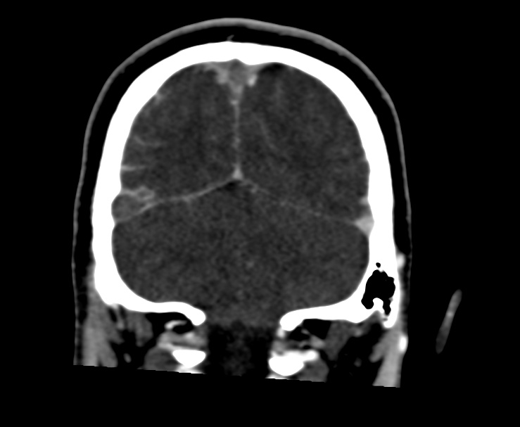 Cerebral venous sinus thrombosis (Radiopaedia 59224-66646 Coronal C+ delayed 63).jpg