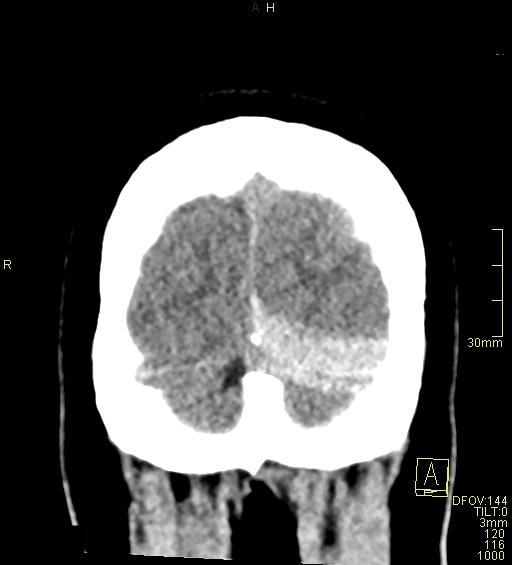 Cerebral venous sinus thrombosis (Radiopaedia 91329-108965 Coronal non-contrast 52).jpg