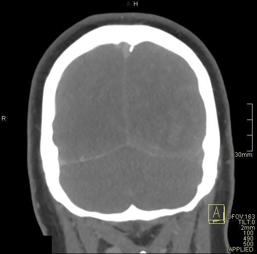 File:Cerebral venous sinus thrombosis (Radiopaedia 91329-108965 Coronal venogram 74).jpg
