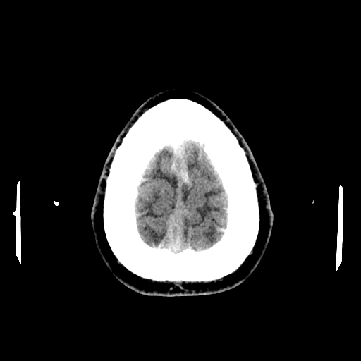 File:Cerebral venous thrombosis (CVT) (Radiopaedia 77524-89685 Axial non-contrast 44).jpg