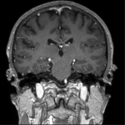 Cerebral venous thrombosis (Radiopaedia 38392-40469 Coronal T1 C+ 40).png