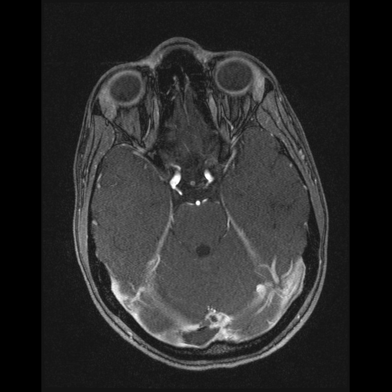 Cerebral venous thrombosis (Radiopaedia 45678-49854 Axial MRV 23).jpg