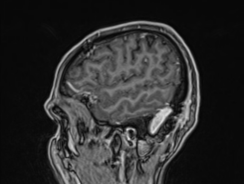 Cerebral venous thrombosis (Radiopaedia 71207-81504 Sagittal T1 C+ 55).jpg