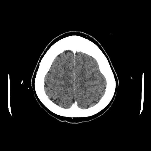 Cerebral venous thrombosis with venous hemorrhagic infarct (Radiopaedia 90354-107660 Axial with contrast 141).jpg