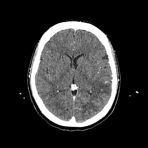 Cerebral venous thrombosis with venous hemorrhagic infarct (Radiopaedia 90354-107660 Axial with contrast 87).jpg