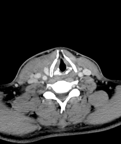 Cervical abscess (Radiopaedia 43725-47184 A 47).png
