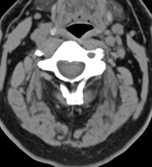 Cervical canal stenosis due to ossification of the posterior longitudinal ligament (Radiopaedia 47260-51823 Axial non-contrast 24).png