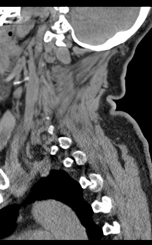 Cervical canal stenosis due to ossification of the posterior longitudinal ligament (Radiopaedia 47260-51823 D 20).png