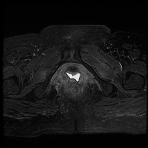 File:Cervical carcinoma (Radiopaedia 70924-81132 Axial T2 fat sat 19).jpg