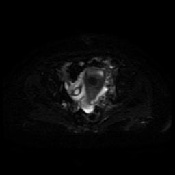 Cervical carcinoma (Radiopaedia 85405-101028 Axial DWI 11).jpg
