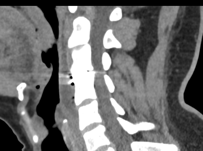 Cervical disc replacement (Radiopaedia 44025-47541 B 46).png