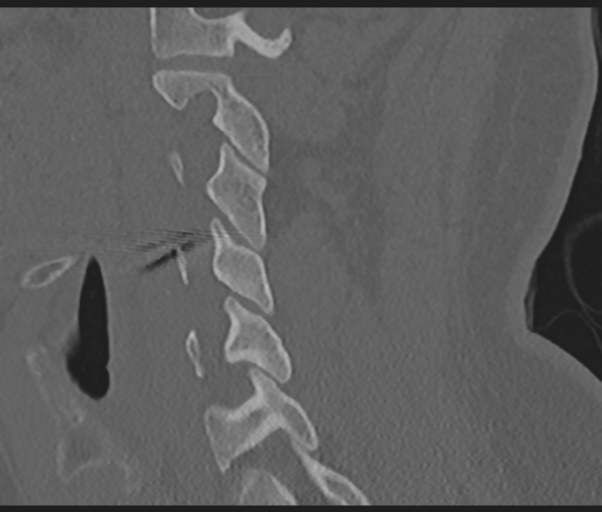 Cervical disc replacement (Radiopaedia 44025-47541 Sagittal bone window 31).png