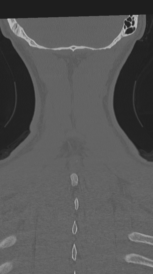 Cervical intercalary bone (Radiopaedia 35211-36748 Coronal bone window 71).png