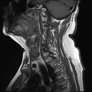File:Cervical spinal neurofibroma in a patient with NF1 (Radiopaedia 58344-65465 Sagittal T1 2).jpg