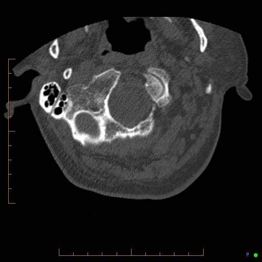 Cervical spine fracture - ankylosing spondylitis (Radiopaedia 76835-88706 Axial bone window 12).jpg