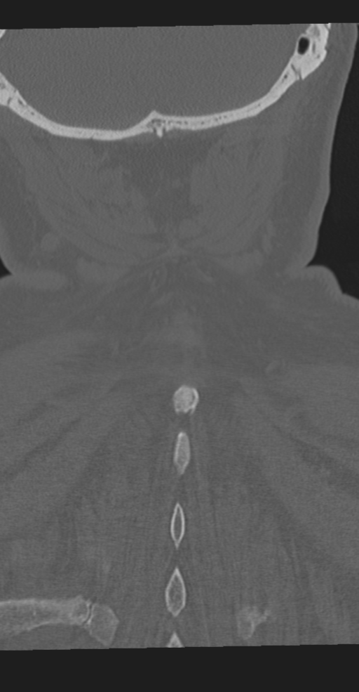 Cervical spine fracture in the setting of ankylosis (Radiopaedia 37038-38715 Coronal bone window 65).png